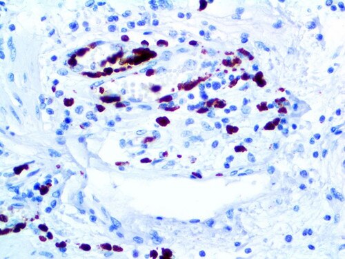 IHC of S100A8/MRP8 on an FFPE Colon Tissue